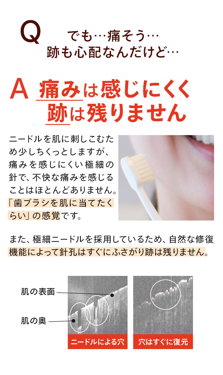 痛みは感じにくく跡は残りません